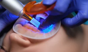 Clinical Use and Operator Impressions with Hard Tissue Laser