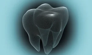 Caries Management using Silver Diamine Fluoride