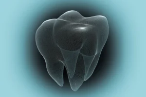 Caries Management using Silver Diamine Fluoride