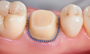 Optimizing Preparations & Gingival Retraction for Scanning