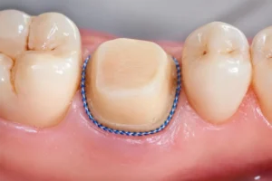 Optimizing Preparations & Gingival Retraction for Scanning